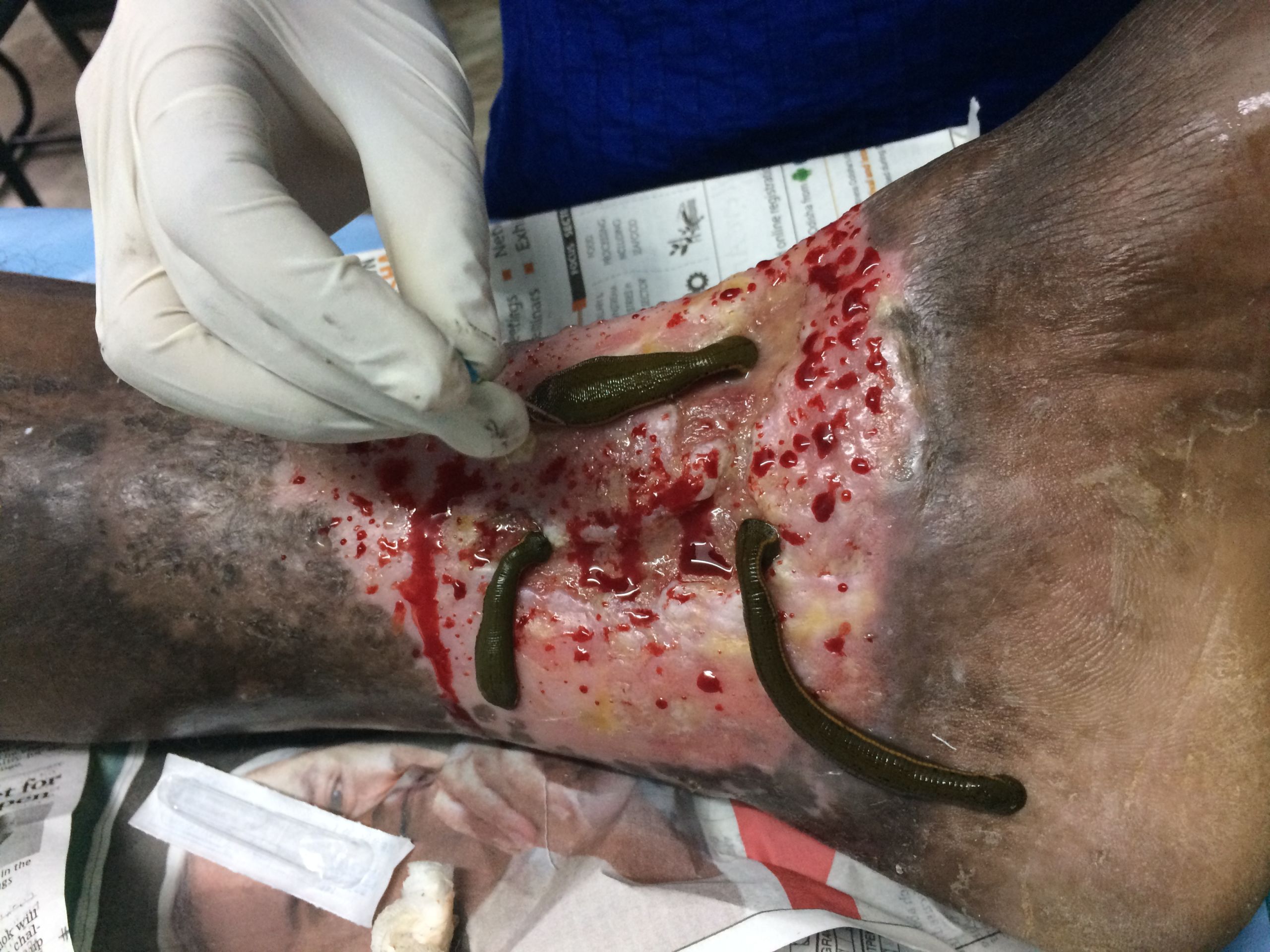 Blood oozing out of leech overed limb
