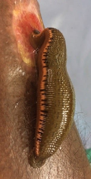 Leech sucking on wound