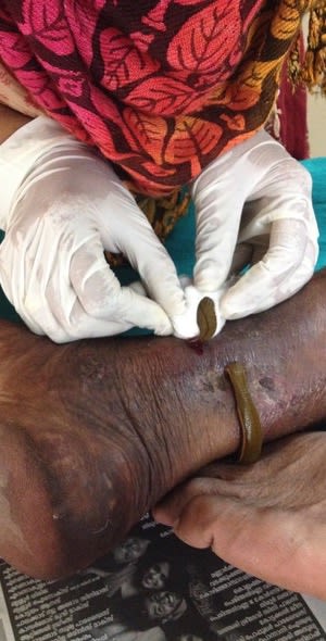 Healer handling leech