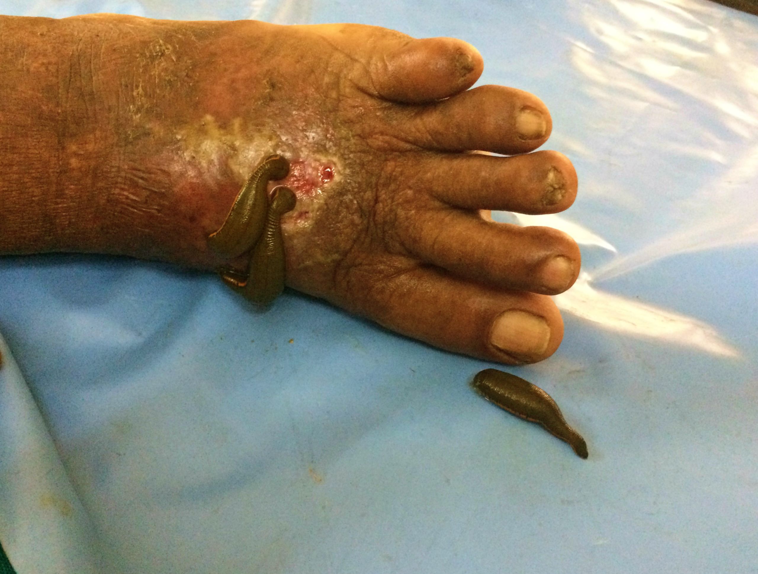 Leeches suck on patient's foot